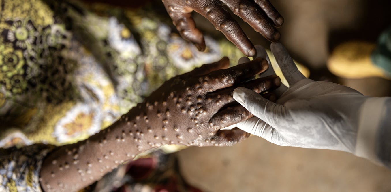 webnexttech | Africa desperately needs mpox vaccines. But donations from rich countries won’t fix this or the next health emergency