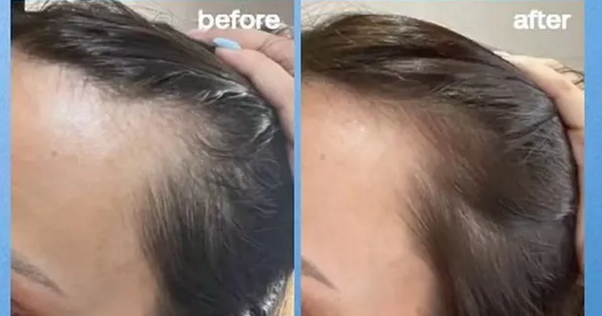 webnexttech | 'In 5 weeks my hair had thickened up': New hair growth serum that 'doubles growth' praised by shoppers